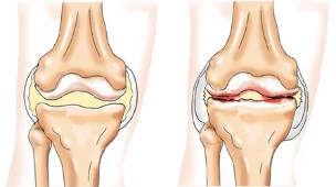 Chondromatous