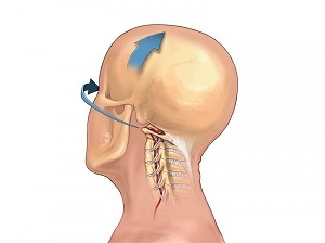 ako sa prejavuje osteochondróza krčnej chrbtice