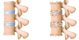 ako rozpoznať prítomnosť osteochondrózy bedrovej chrbtice