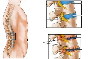 príčiny osteochondrózy bedrovej chrbtice