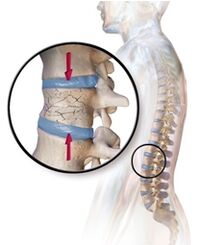 Osteoporóza vyvoláva bolesti chrbta v bedrovej oblasti