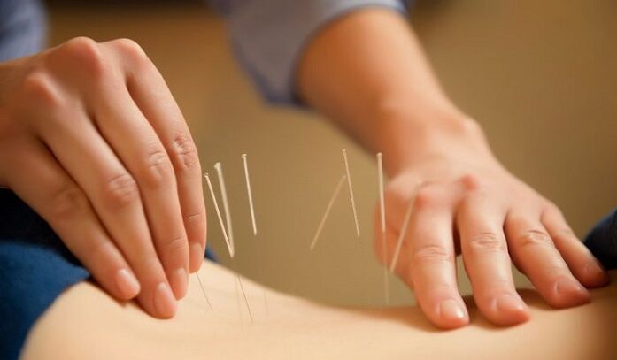akupunktúra na liečbu bolesti krížov
